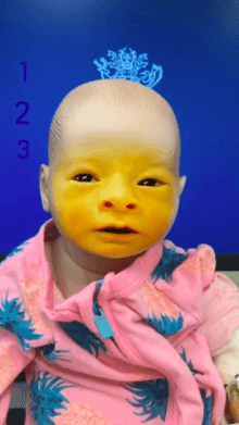 Jaundice Simulator