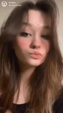 freckles