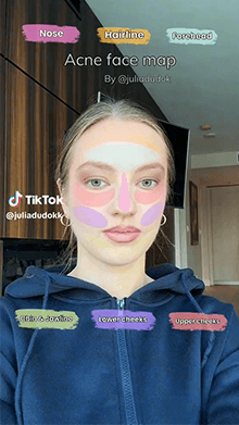 Acne face map